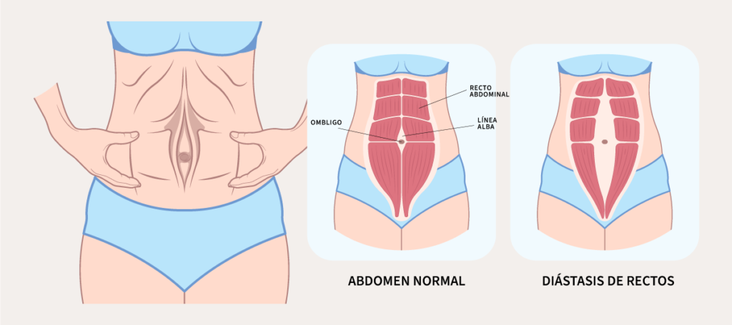 Diástasis de rectos: síntomas, causas y prevención