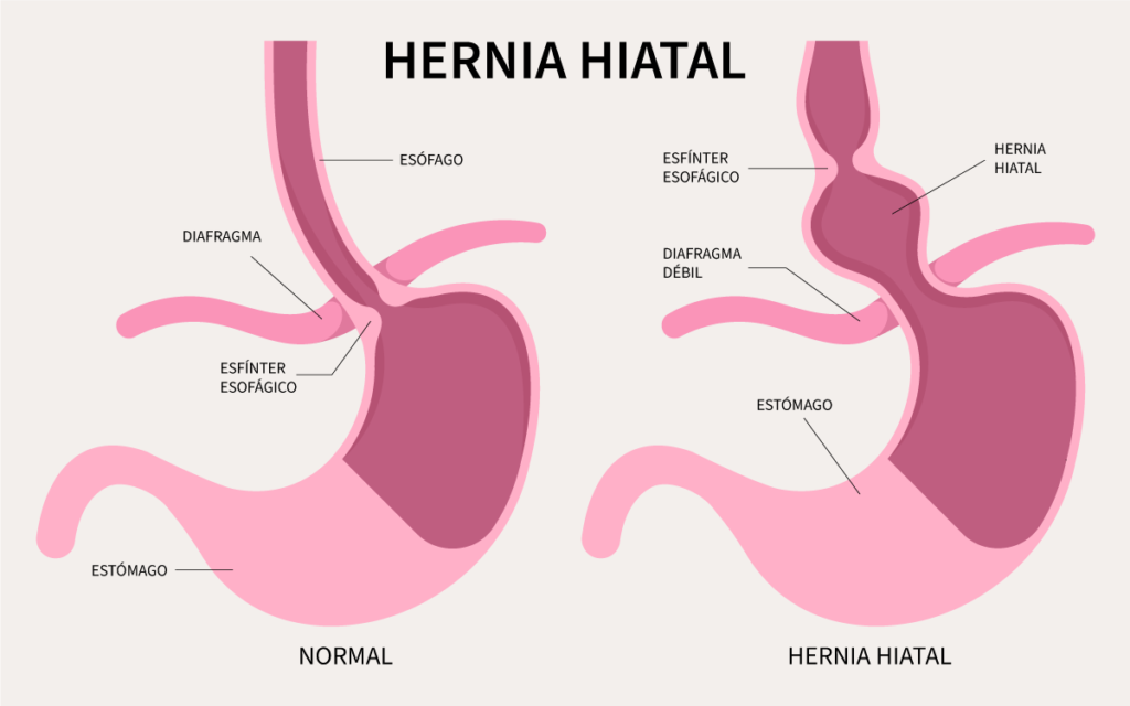 Hernia hiatal o de hiato: síntomas, causas y prevención