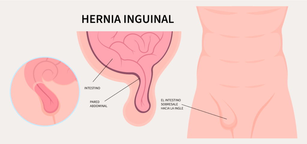 hernia inguinal: síntomas, causas y prevención