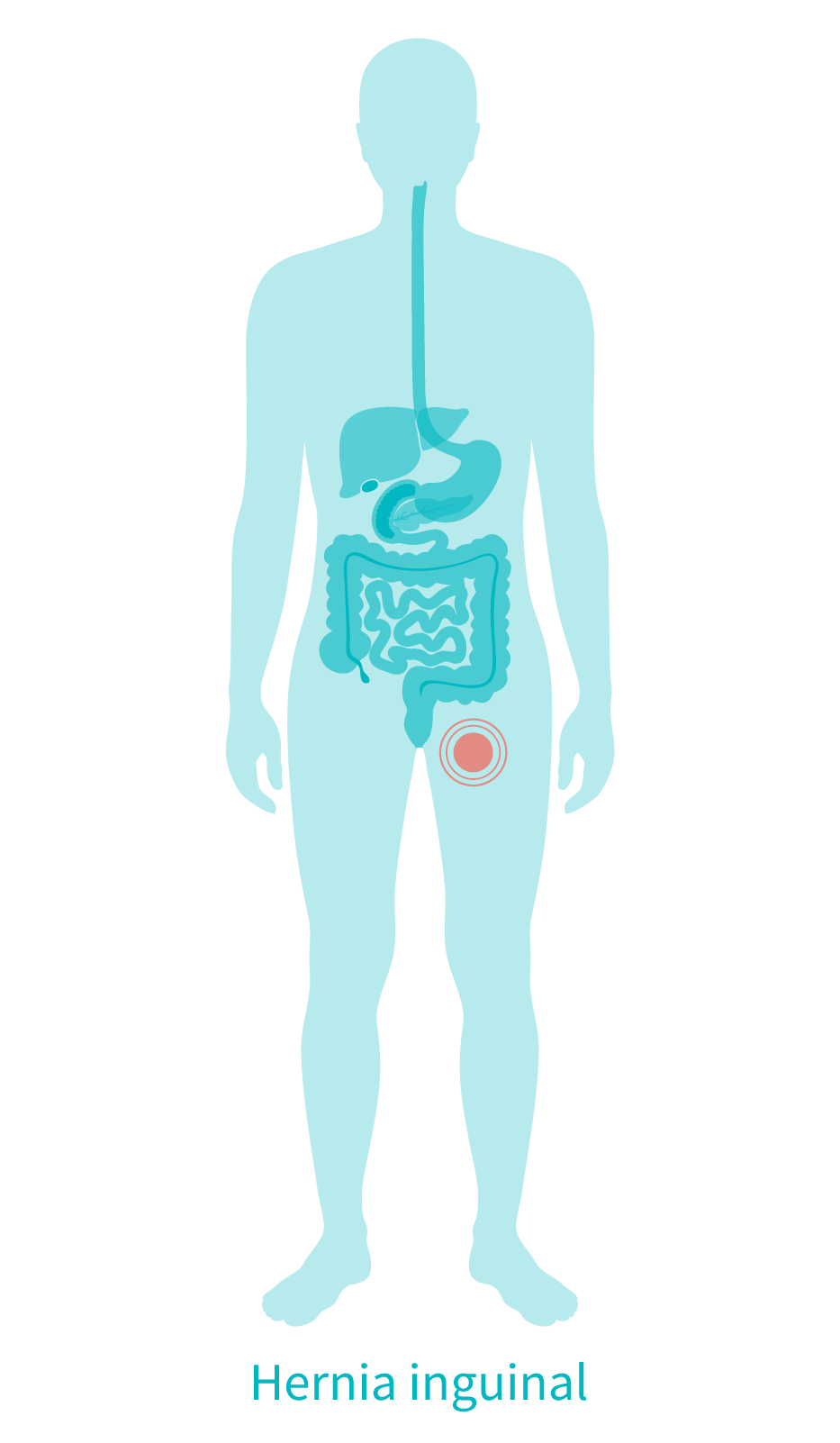 infografía de una hernia anguinal