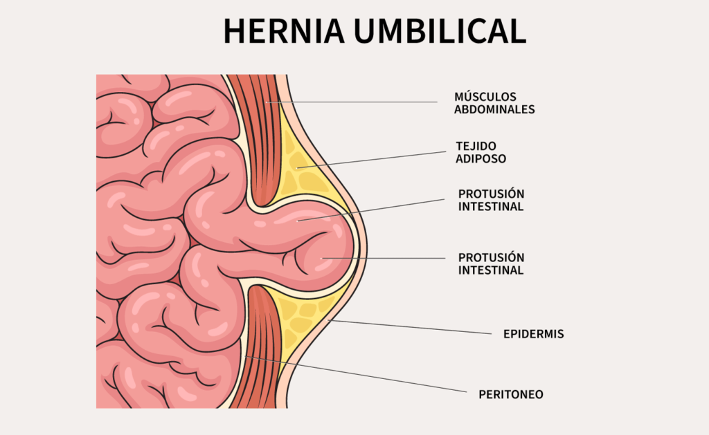 Hernia umbilical: síntomas, causas y prevención