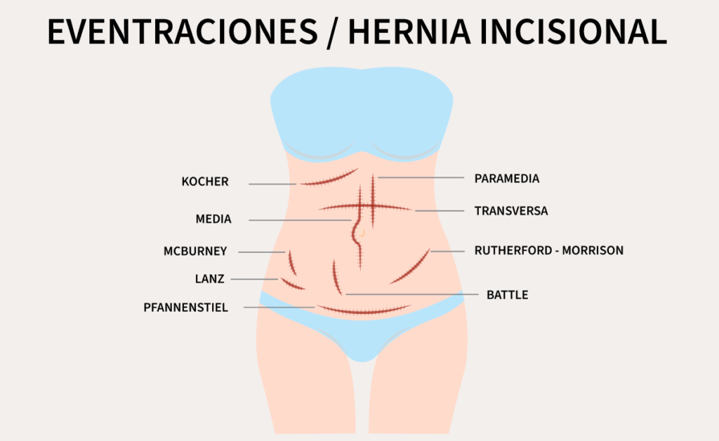 hernia incisional o eventración