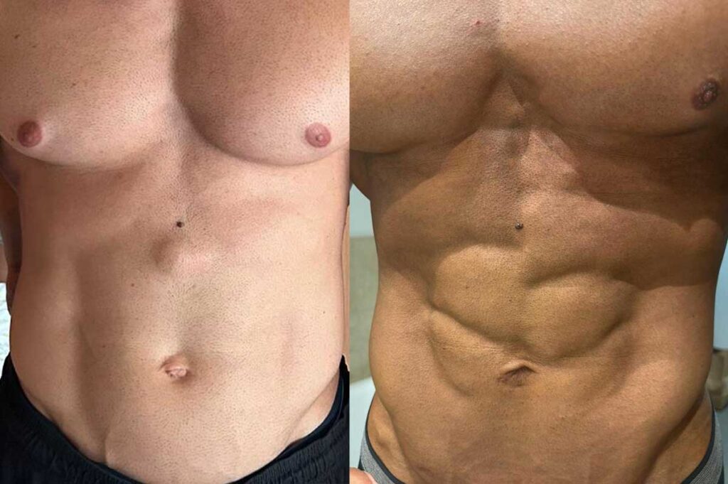 antes-despues-cirugia-hernia-deportista