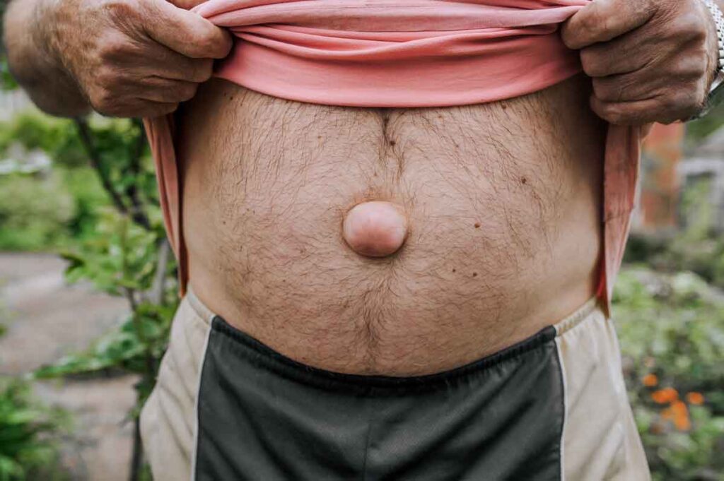 Síntomas y diagnóstico de la hernia umbilical en Hernia Center Málaga