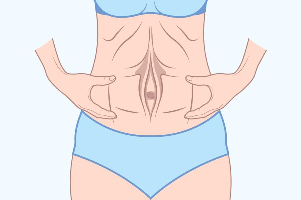 Ilustración de diástasis abdominal posparto (músculos rectos separados tras el embarazo)