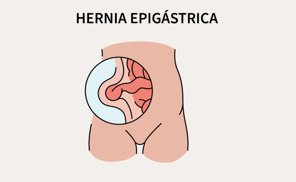 hernia epigástrica
