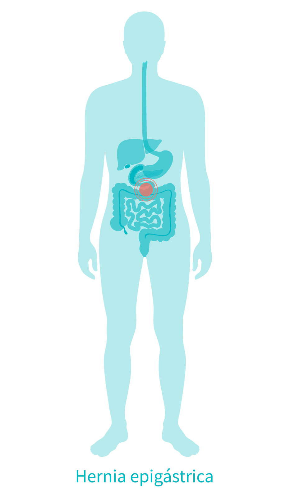infografía hernia epigastrica