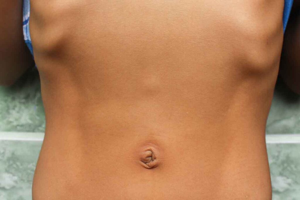 fotografia de una hernia epigastrica