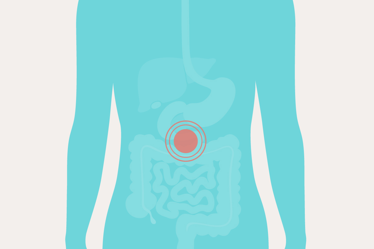 hernia epigástrica