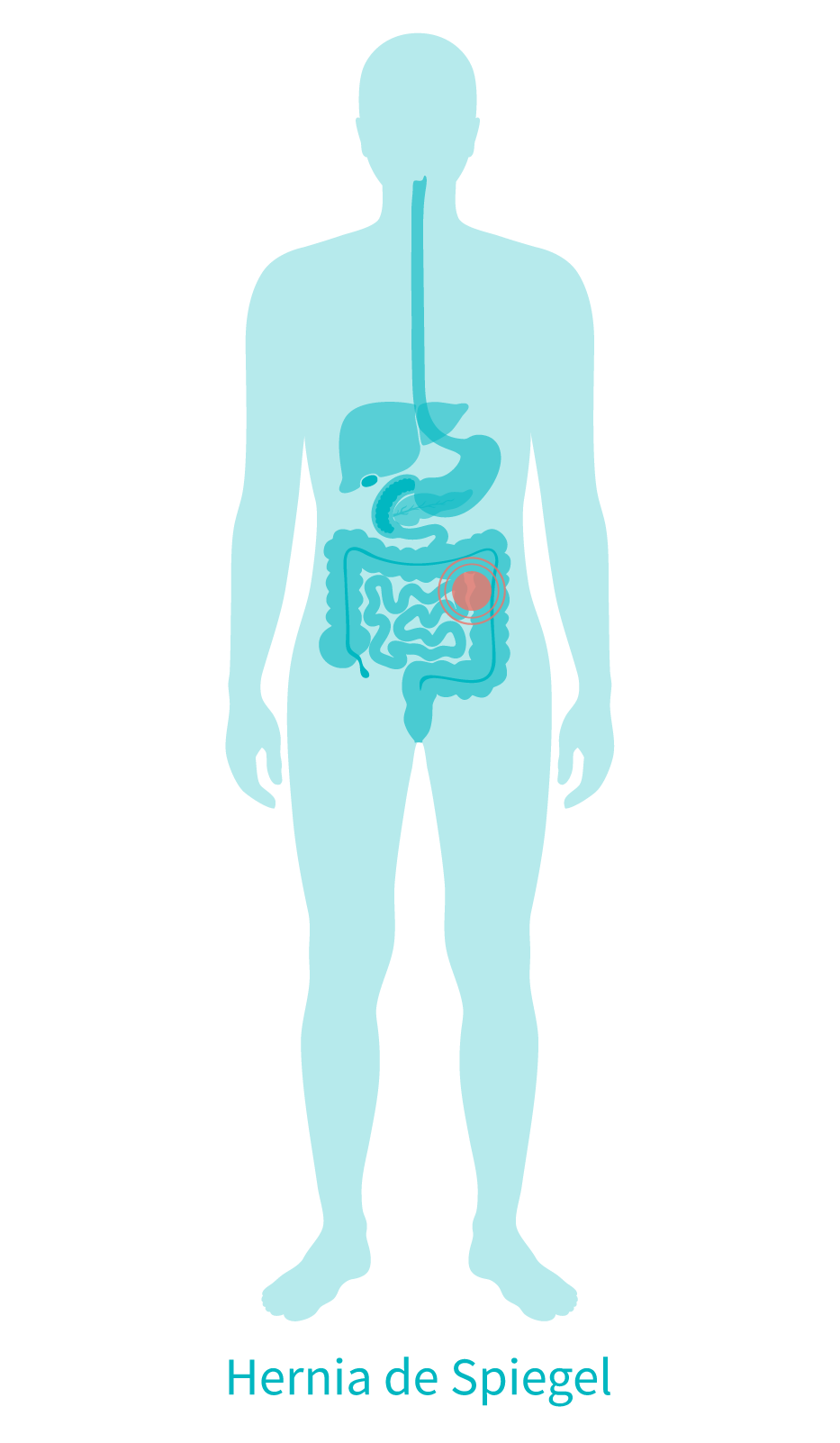 hernia spiegel esquema