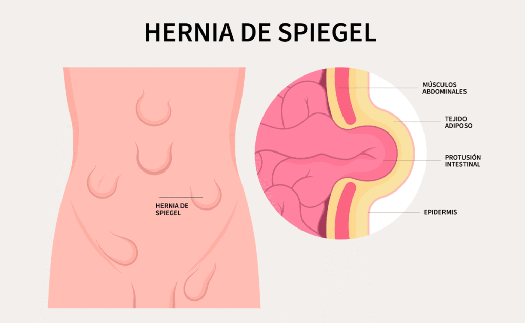 hernia spiegel infografía