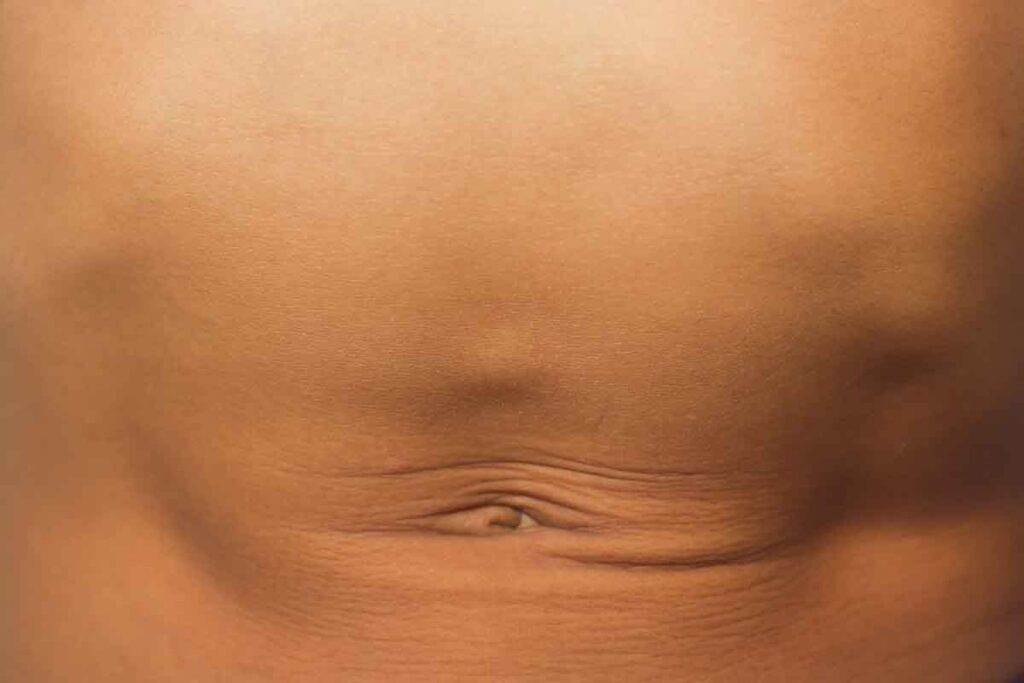 Síntomas de hernia epigástrica: bulto en la línea alba sobre el ombligo