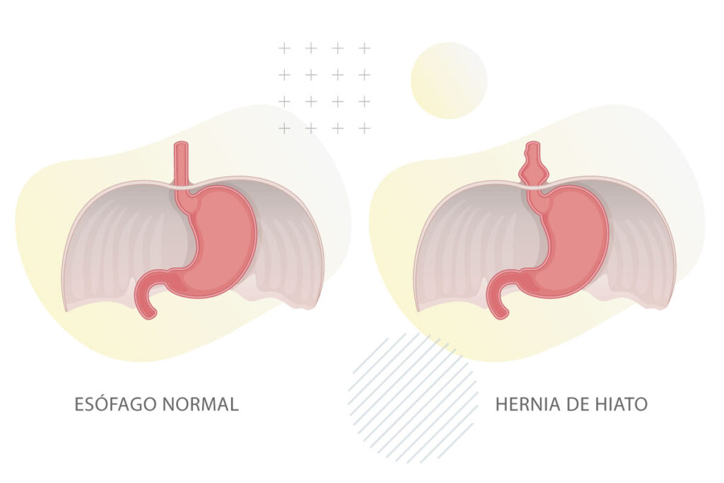 operación de hernia de hiato por laparoscopia – Dr. Rivas Becerra – Hernia Center